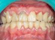 Gum Disease