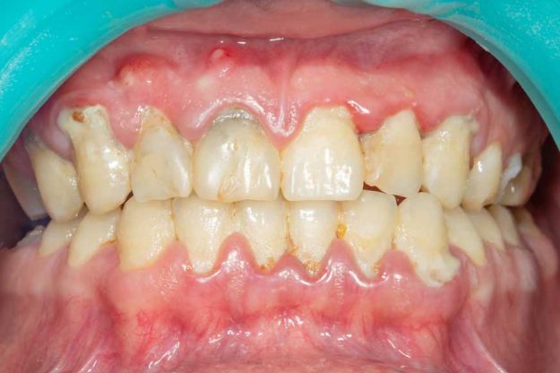 Gum Disease Gum Disease