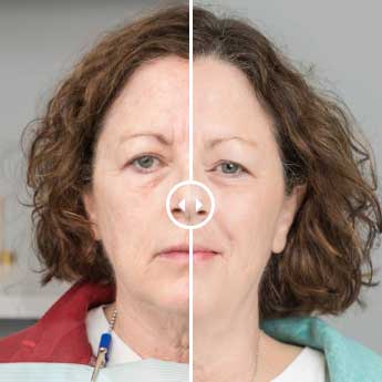 Platelet-Rich Fibrin Facial (PRF)