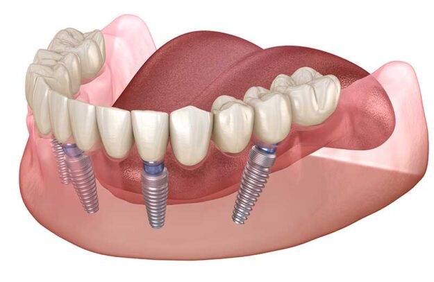 Implant Supported Denture Implant Supported Denture